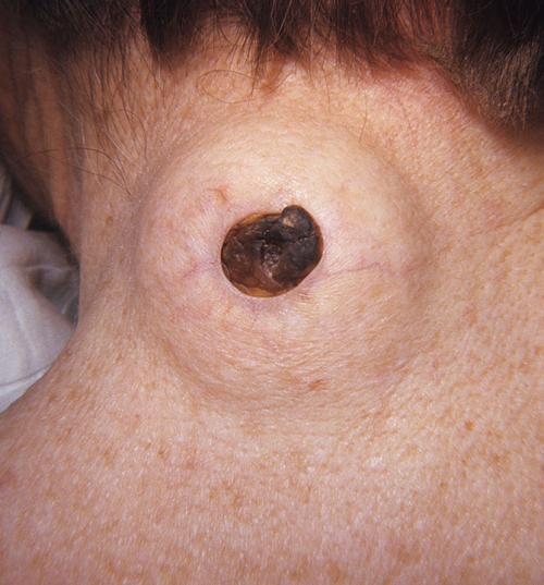 zit zits pop that zit acne treatment acne creams pimple popping cysts